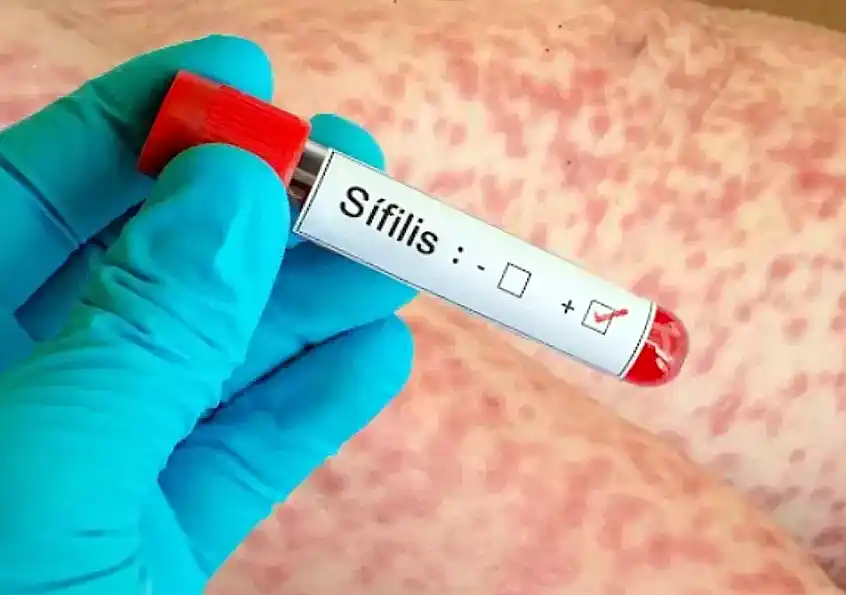 Alerta sífilis