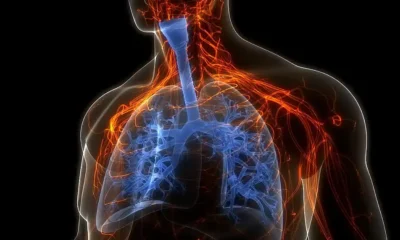Monóxido de carbono intoxicación